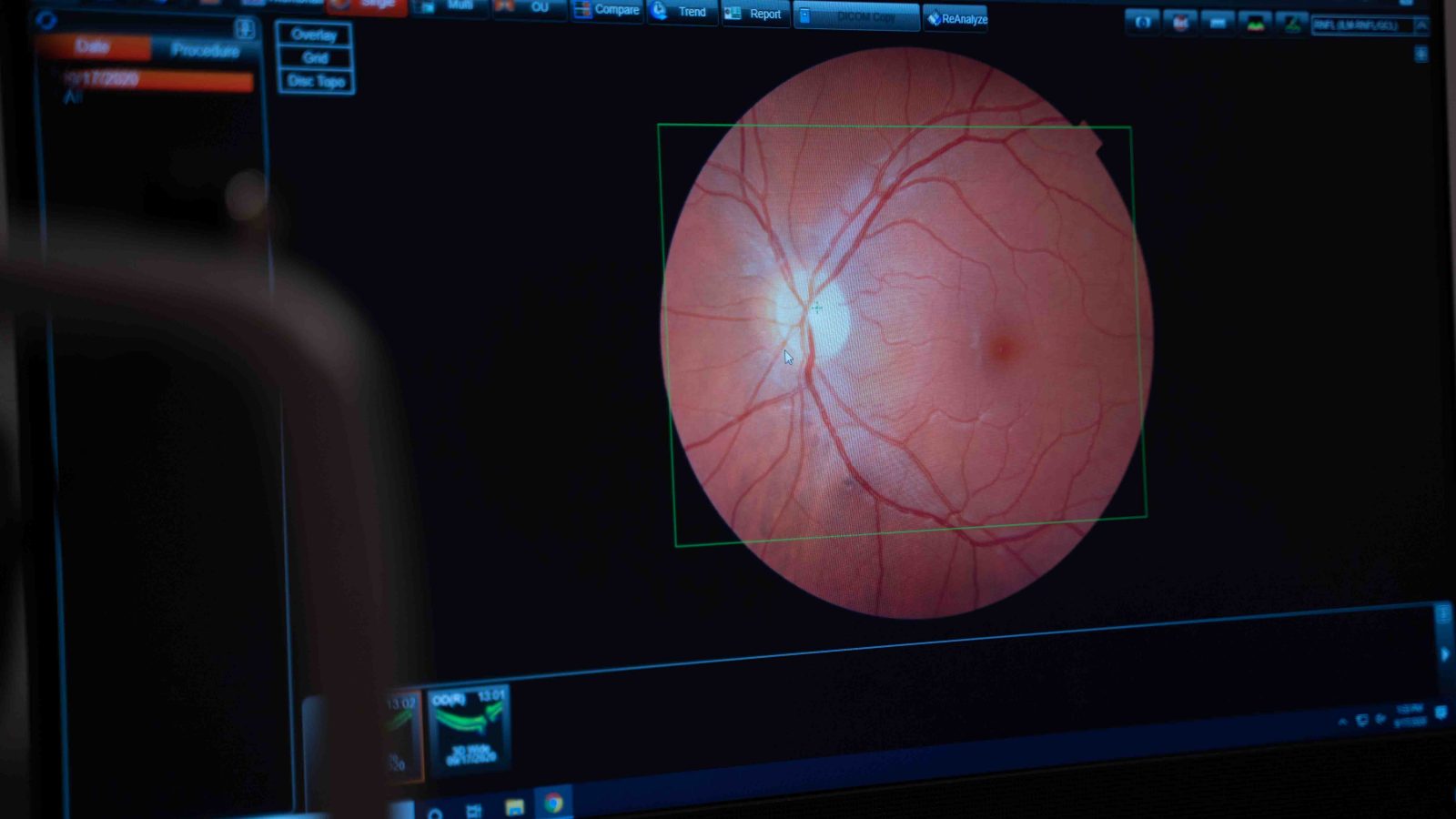 Retinal Imaging and Macular degeneration testing